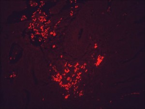 IF detection of Hsp90 in cancerous human colon tissue, using Anti-Hsp90 (clone: H9010)