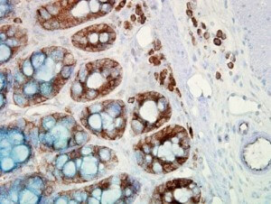 IHC detection of Hsp90 in cancerous human colon tissue